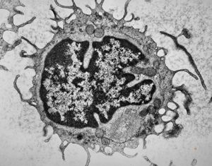 M,81y. | blood - hairy cell leukemia